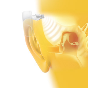 How a Bone Anchored Hearing Aid Works